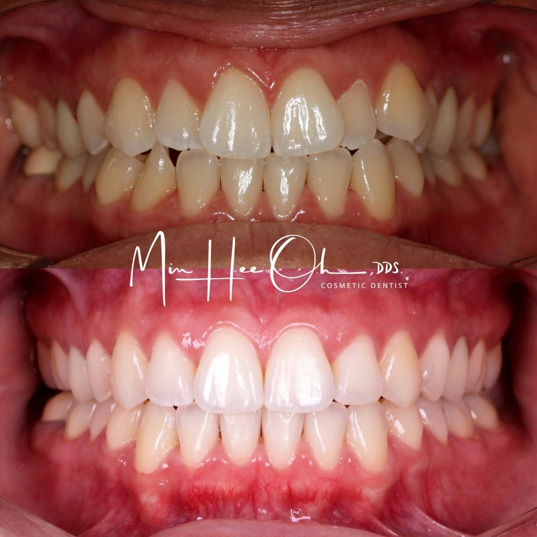 Before and after smile with whiter, more even teeth by Dr. Min Hee Oh