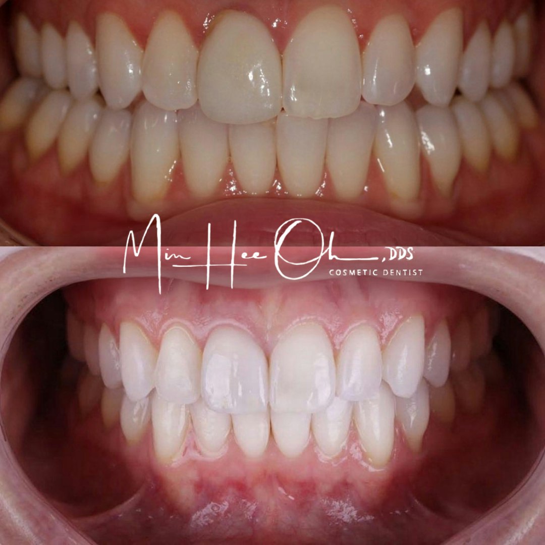 Before and after restored, brighter smile by Dr. Min Hee Oh