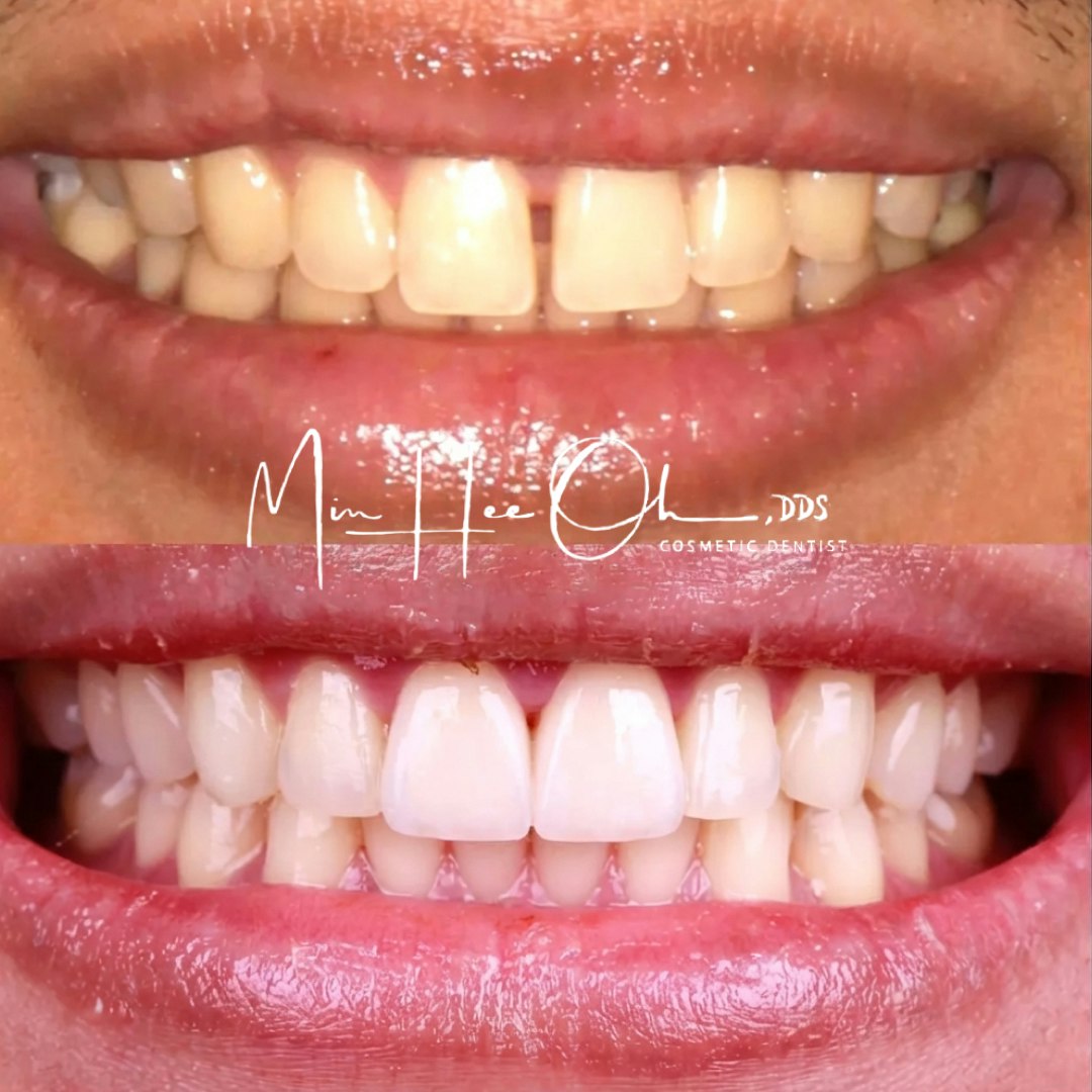 Before and after smile with a closed front-tooth gap by Dr. Min Hee Oh