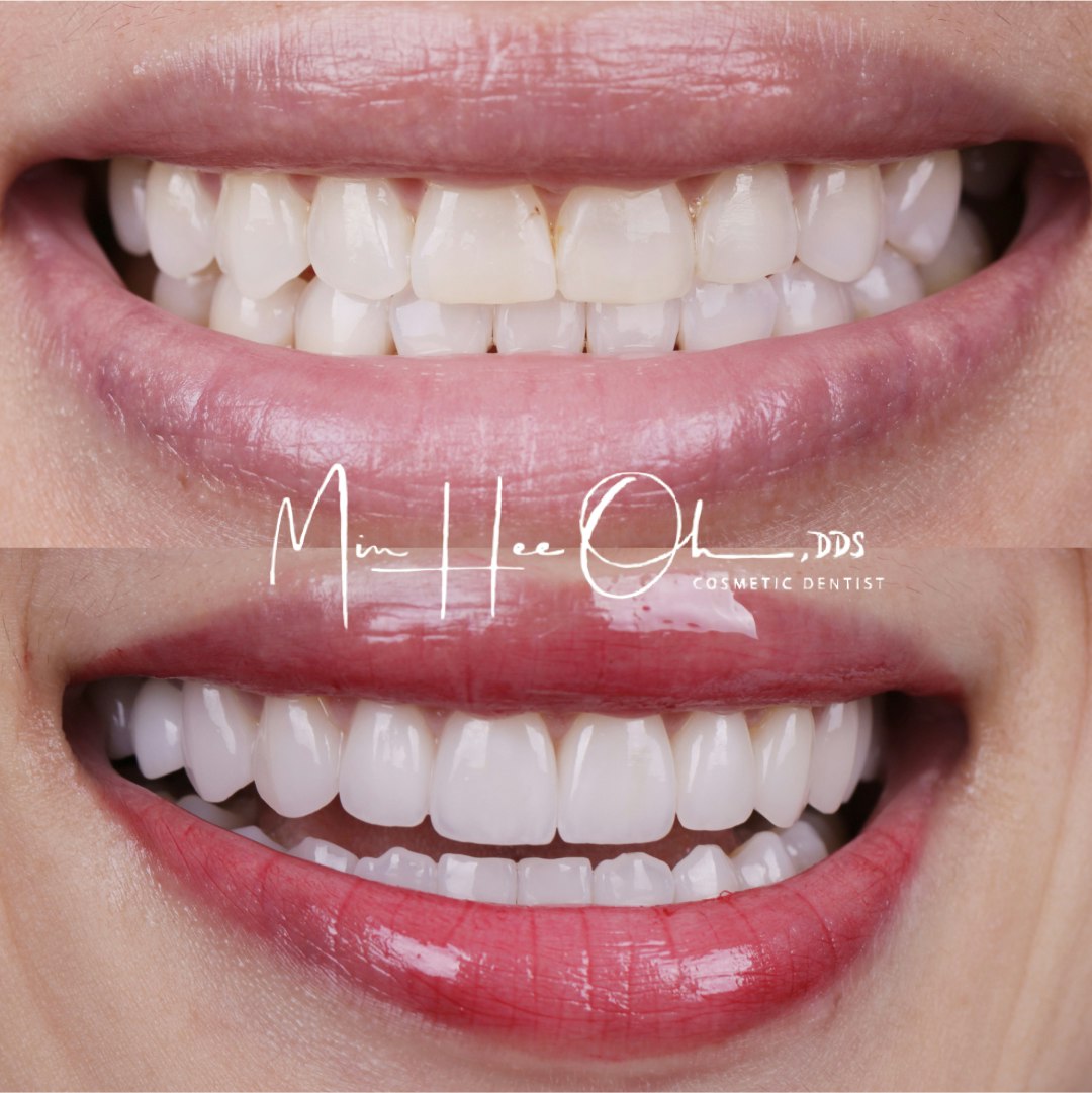 Before and after porcelain veneer smile makeover by Dr. Min Hee Oh